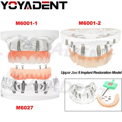 Dental Overdenture Restoration Teeth Model Upper/Lower Jaw Type With 4/6 Screws