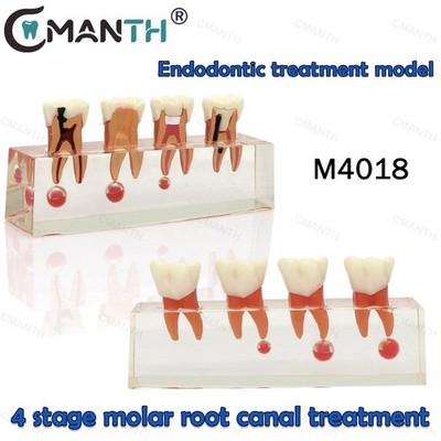 Dental Model Endodontic Treatment 4-Stage Root Canal Caries Student Practice