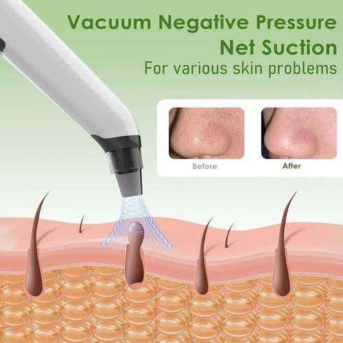Blackhead Remover Vacuum - USB Charging - 3 Levels - 4 Probes - Afbeelding 4 van 4