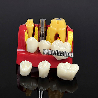 Dental Implant Analysis Crown Bridge Demonstration Teeth Model Remove Teach Lab