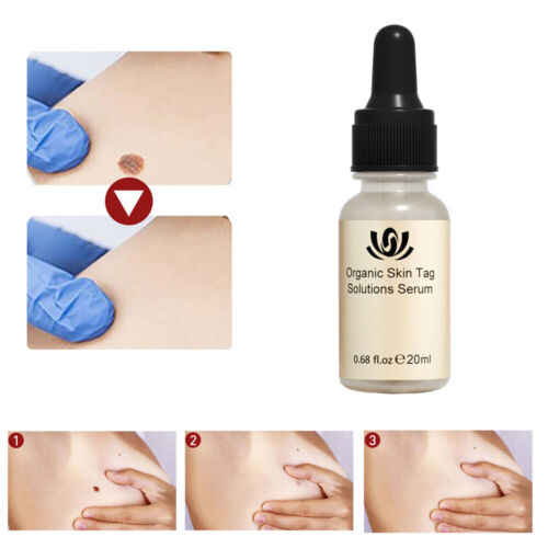 12 Hours Wart Remover Skin Tags Mole Remover Eliminate Foot Corn Wart . - Picture 7 of 12