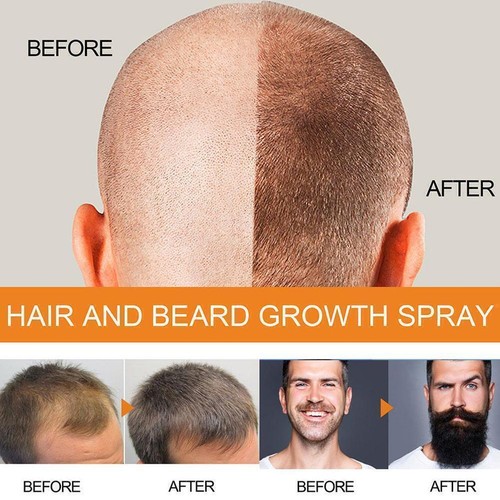 100ml Hair Growth Spray 5 % Mino xidil For Men Women Regrowth S6K5 Hair-- R5N2 - Picture 8 of 12