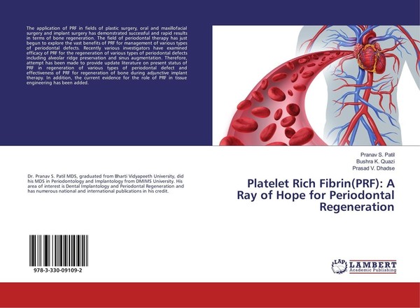 Platelet Rich Fibrin(Prf): A Ray Of Hope For Periodontal Regeneration Pranav S.-image