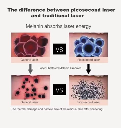 Máquina láser de picosegundos 3 en 1 ND Yag eliminación de tatuajes interruptor Q rejuvenecimiento de la piel - Imagen 4 de 16