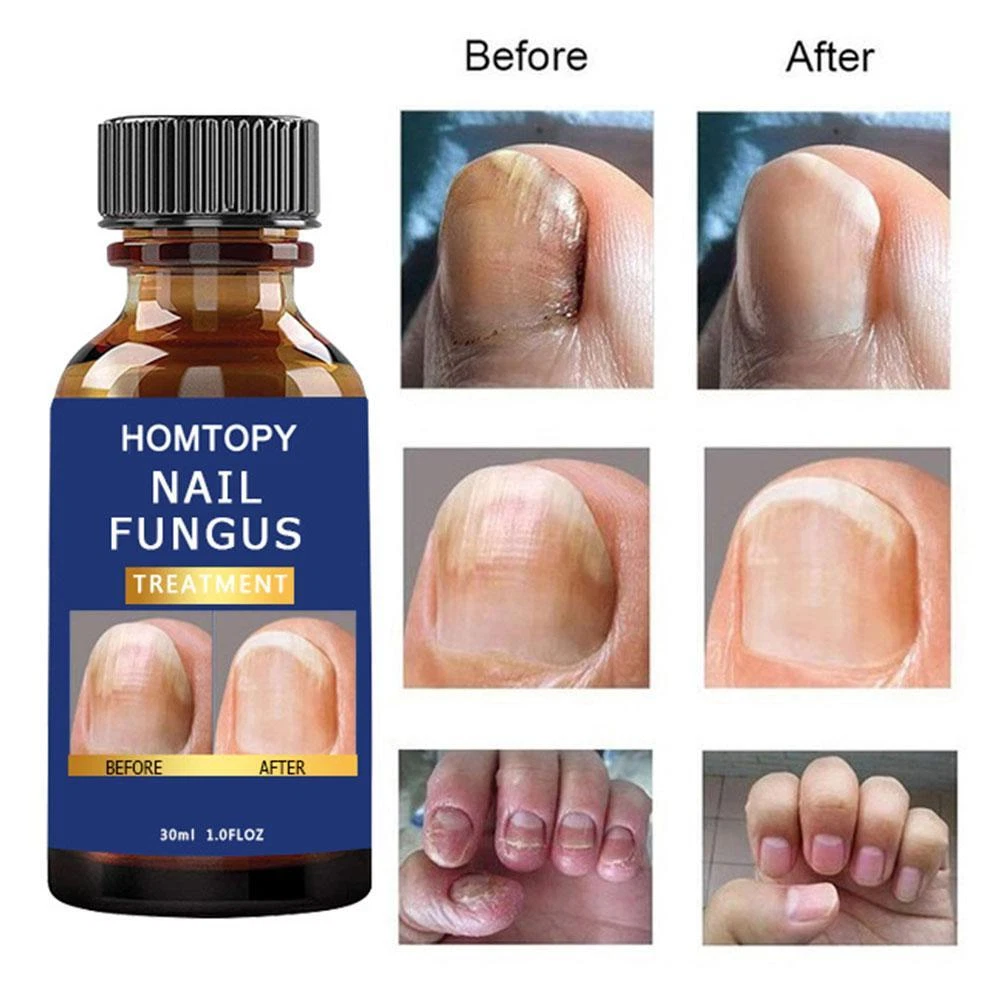 Discover more than 148 antifungal nail liquid best ceg.edu.vn