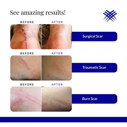 REJUVASIL Silicone Scar Gel 10ml Suitable for surgical, pediatric & facial scars - 第 8/11 張圖片