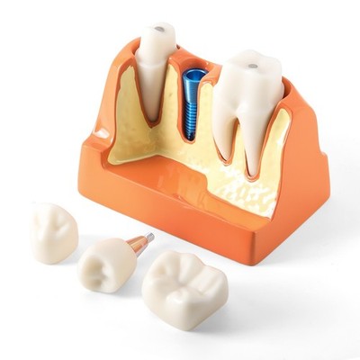 Dental 4 Times Teeth Model Implant Analysis Crown Roots Demonstration Removable