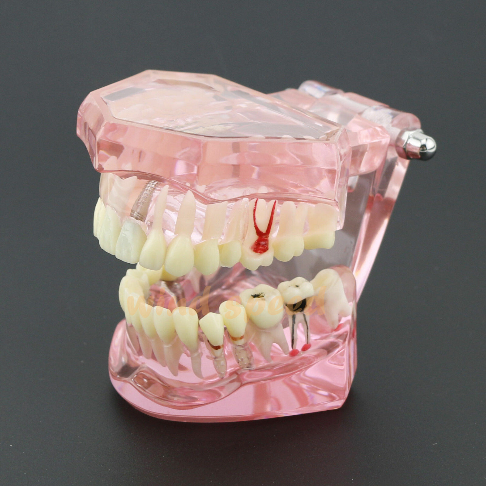 Dental Implant Teeth Model Study Analysis Demonstration Disease