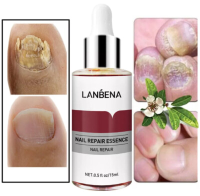 Anti Fungal Nail Treatment fungu Nail Finger Toe Fungus Onychomycosis Remover