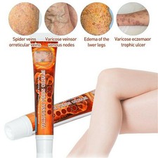 Herbal Medical Gips Krampfadern Salbencreme Bein Vaskulitis entfernen Creme