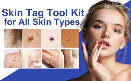 Fast & Easy Skin Tag Remover Kit: Micro & Medium (2-8.5mm) for All Skin Types - Picture 2 of 5