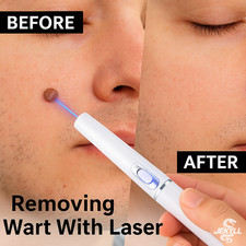Maquina Laser Lapiz Dispositivo Remover Eliminar Verrugas sin dolor sin agujas