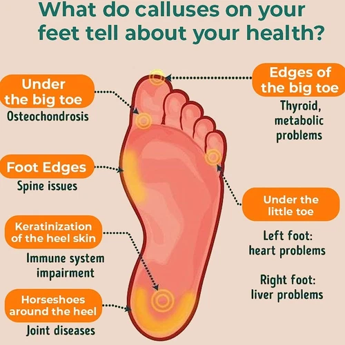 Foot Callus Removal Spray, Foot Heel Callus Remover Spray, Foot Peel Spray - Picture 6 of 12