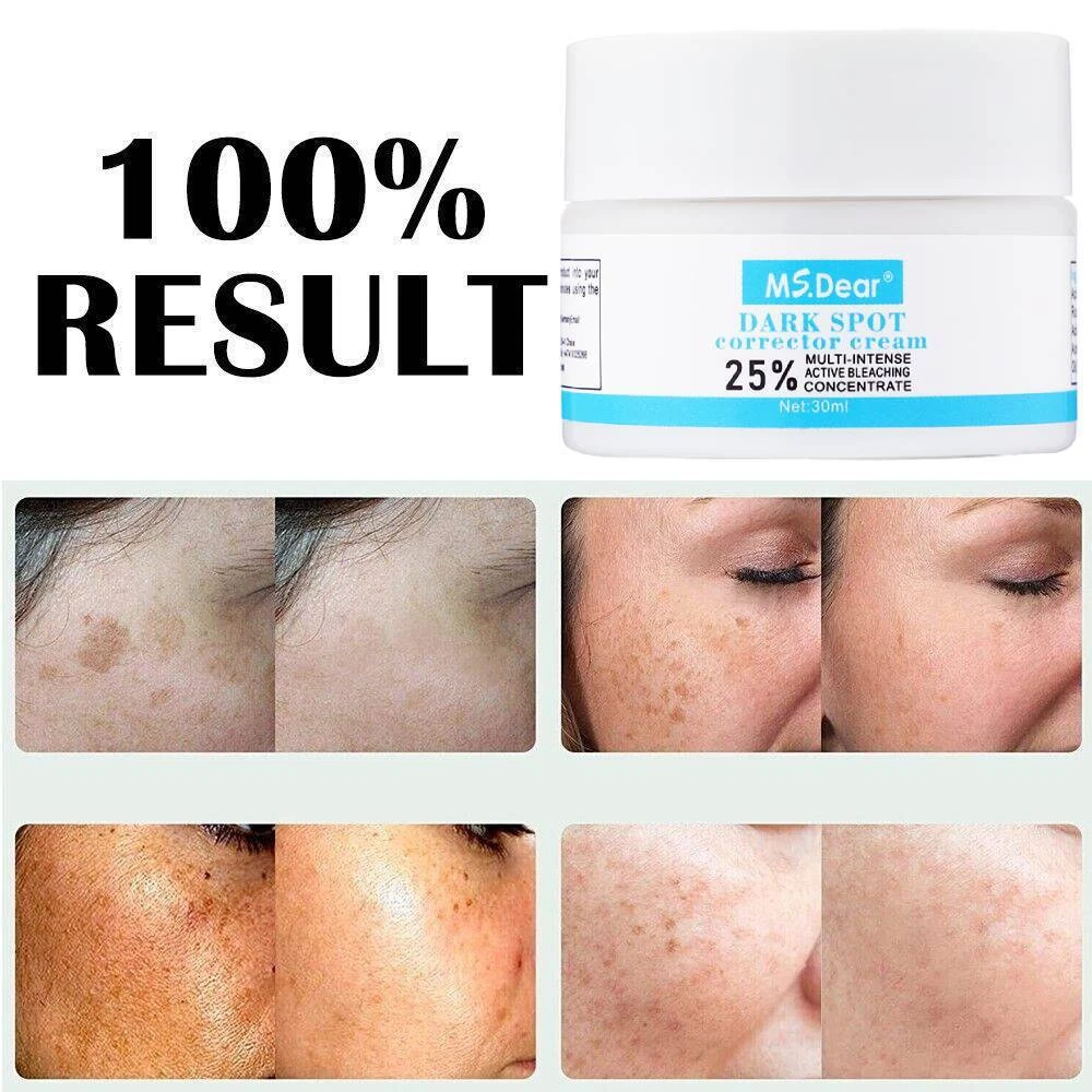 Best Black Spot Removal Cream