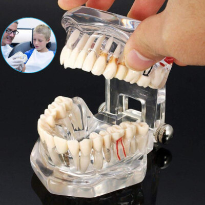 Dental Typodont Teeth Study Model Ortho Implant Disease Education Denture