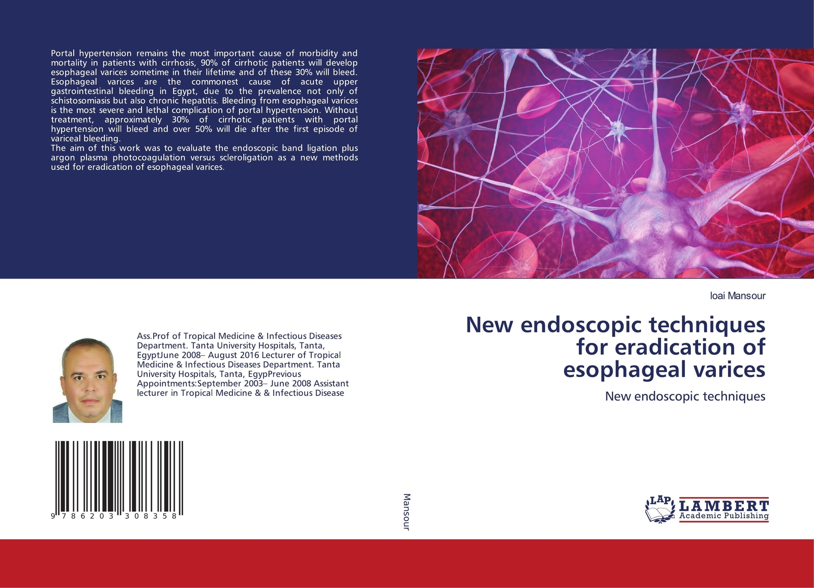 Thumbnail - Endoscopic Techniques For Eradication Of Esophageal Varices Loai