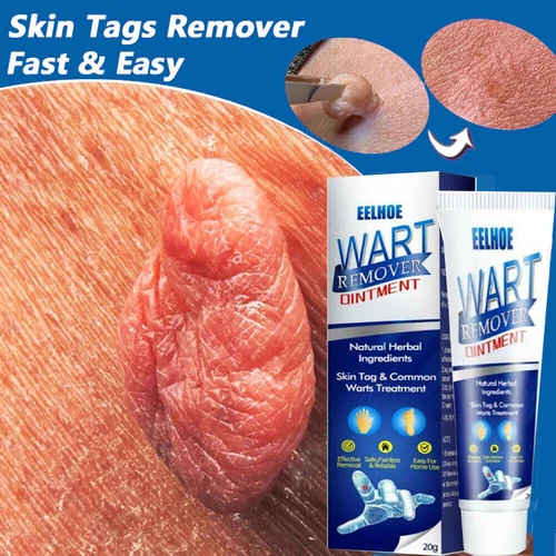 Warzen Entfernung Haut Tag Behandlung Creme Wart Remover Warze Entferner - Bild 2 von 21