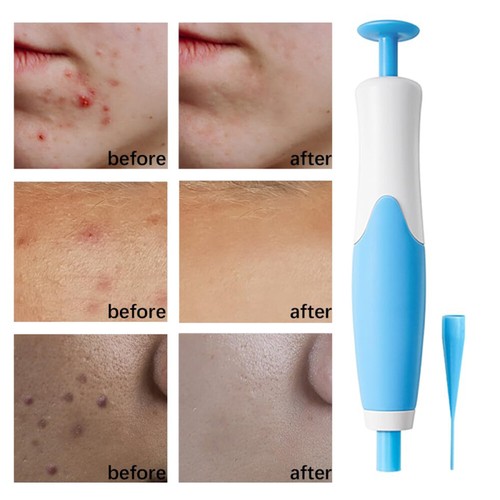 Wart Remover Kit 2in1 Wart Papilloma Skin Tag Remover Painless Remover - Picture 12 of 19