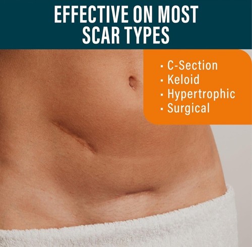 Silicone Scar Sheets Extra Long Scar Sheets for C-Section Tummy Tuck Light Tone - Picture 4 of 9