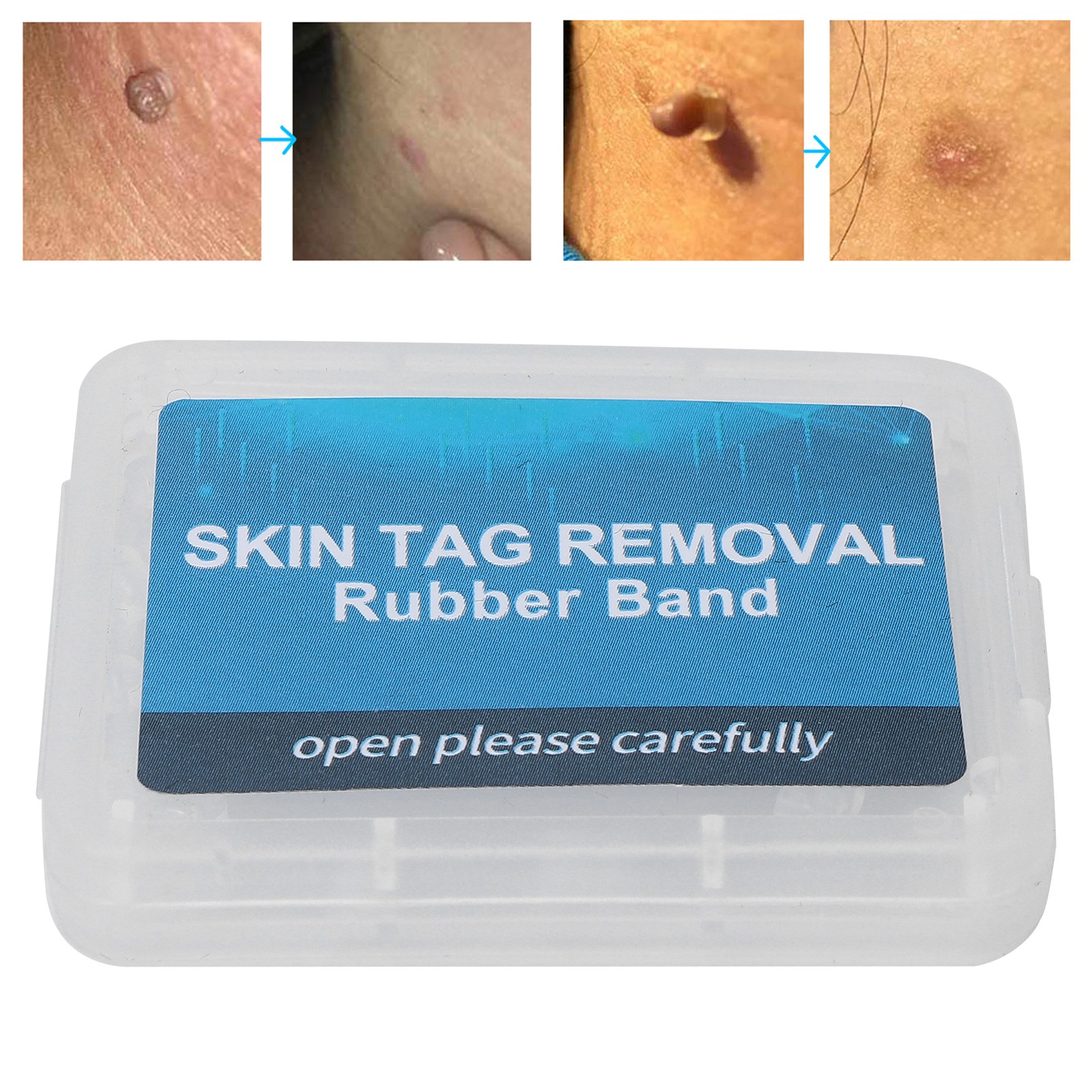 Bands Refill for Small/Medium Skin Tags Removal for Both Tag Remover Device