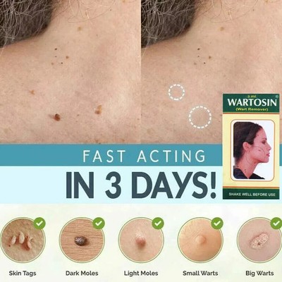 2x NEW SKIN TAG REMOVER CREAM SAFE FAST WART REMOVAL MOLE ACNE PIMPLE PATCH SPOT