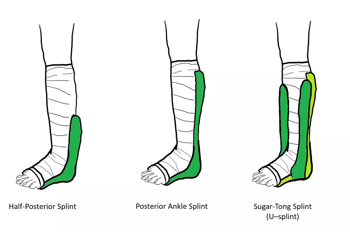 Sprained Ankle Splint