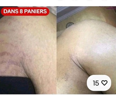 Creme DehnungsstreifenCreme Haut Körper Dehnungsstreifen Mutterschaft Narbenreparatur Repariert