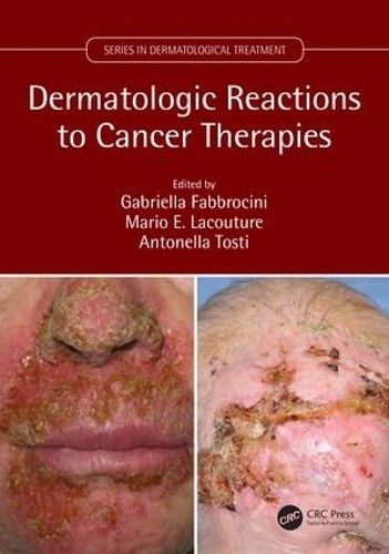 Dermatologic Reactions to Cancer Therapies by Gabriella Fabbr... - 9781138035539