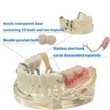 Typodont Restoration Dental Teeth Model With Partial Denture Demo 2 Implants