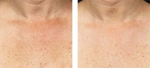 Crema reafirmante para el cuello Reductor de doble mentón, tratamiento para cuello y pecho - 4oz Foto 3 de 4