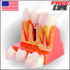 Dental Implant Model with Removable Crown Bridge Enlarged Demonstrative Teeth