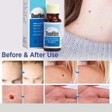 1-6x Duofilm 15ml Salicylic Acid Remove Plantar Warts Corns Calluses Treatment