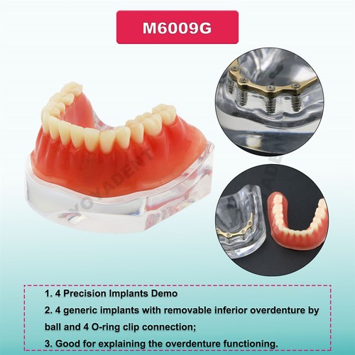 Multiple Types Dental Teeth Model Ortho Implant Practice Teaching Demo Model - Picture 216 of 276