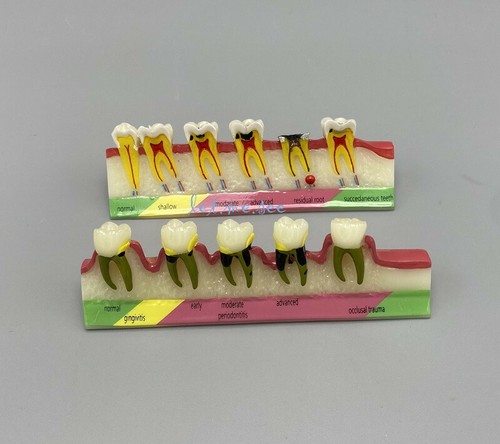 Dental Teaching Study Models Periodontal Caries Disease Assort Dentoform Model - Picture 15 of 15