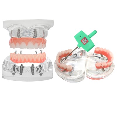 Modèle Dentaire All-on-4 - Implants Inférieurs Amovibles Avec 4 Vis - Réf. M6027-US - Neuf