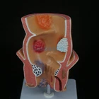 Anatomical Human Rectum Pathology Lesion Model Hemorrhoids Anus Medical Teaching