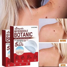 MICRONEEDLE HOT BOTANIC Skin Tag  Acne Patch Skin Tag Remover Patches