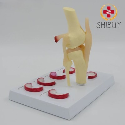 Life Size Knee Joint Model with Ligaments Shows Meniscus Tears Anatomical Model