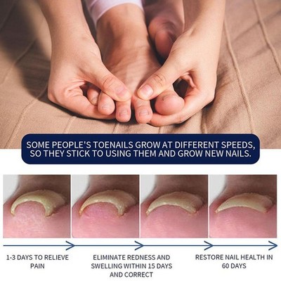 Toenail Treatment Oil Nail Strengthener Softening Cuticle Moisturizing Care