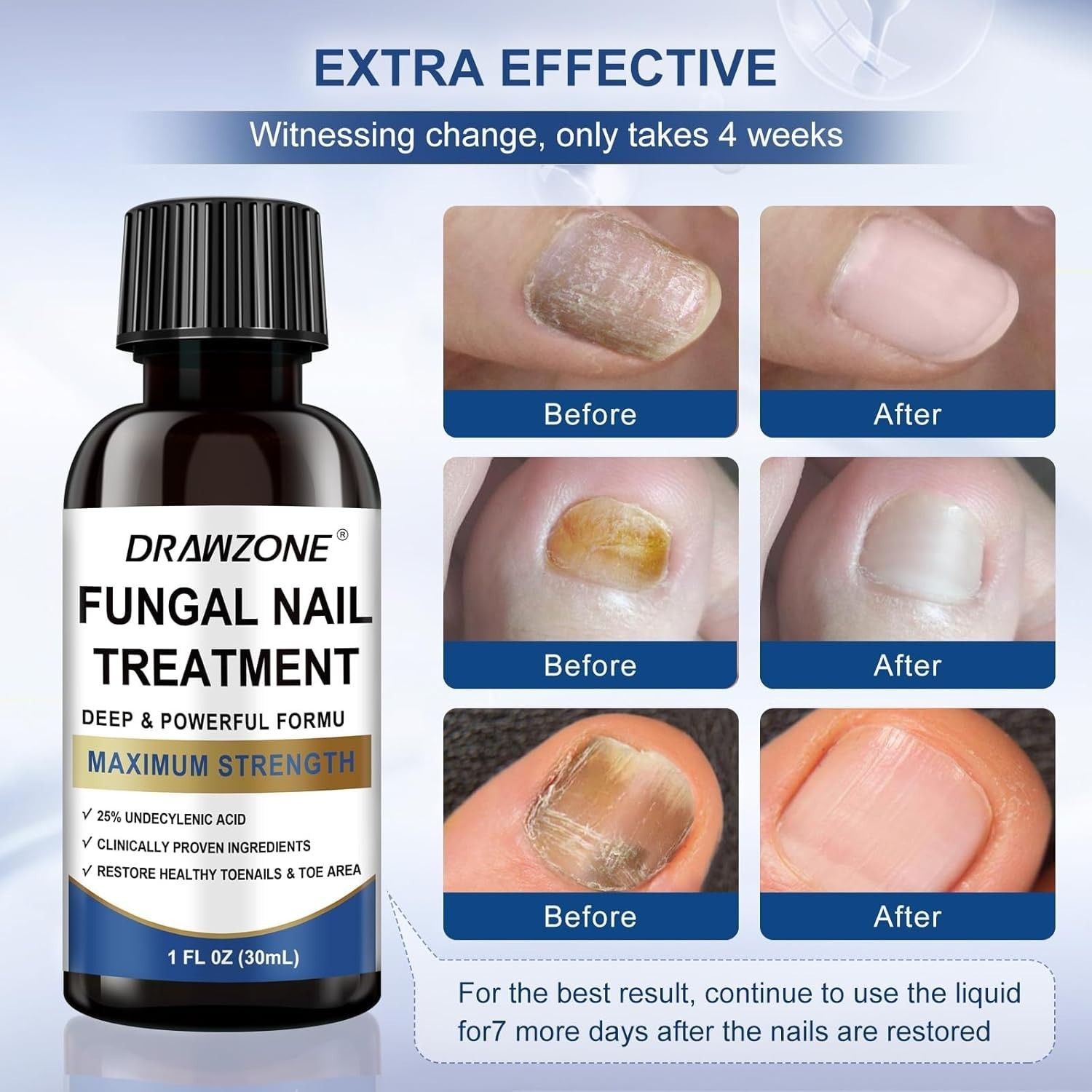 Fungus Treatment For Toenail, 25% Undecylenic Acid, Ingrown Nail repair Strength