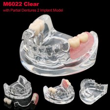 Dental Typodont Restoration Teeth Model with Partial Dentures 2 Implants Demo