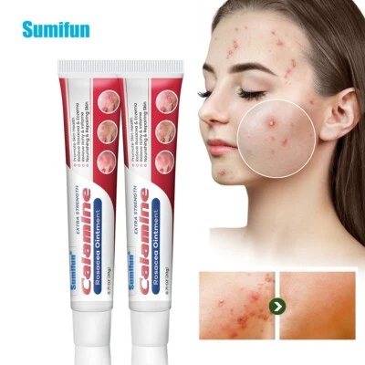 SUMIFUN New 20g Rosacea Ointment Treat Red Nose Acne Cream Pimple Scar Repair Skin Care