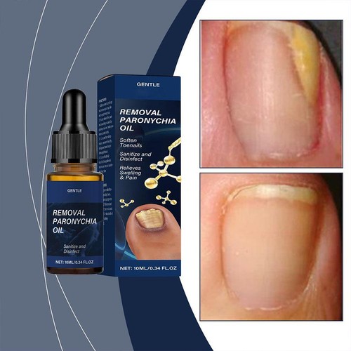 Cure Ingrown Toenail Treatment Infection Nail Care Oil Removal Paronychia |U.S - Picture 6 of 17