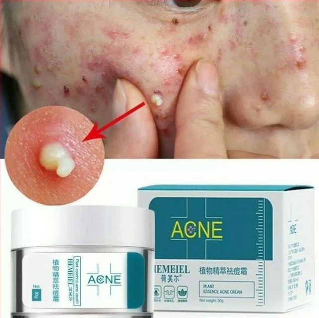 striae treatment cream