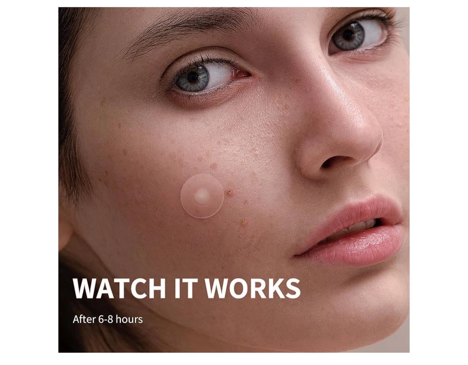 Pimple Patches for Face, 4 Size 300 Counts Acne Patches - Image 4 of 4