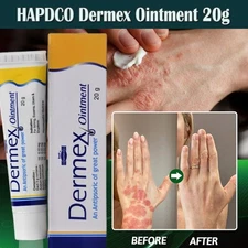Psoriasis Dermatitis Eczema Cream Dermex Ointment 20g