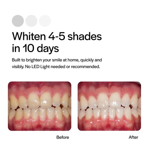 Opalescence Go 15 PF - Prefilled Teeth Whitening Trays - 10 Treatments - Afbeelding 4 van 9