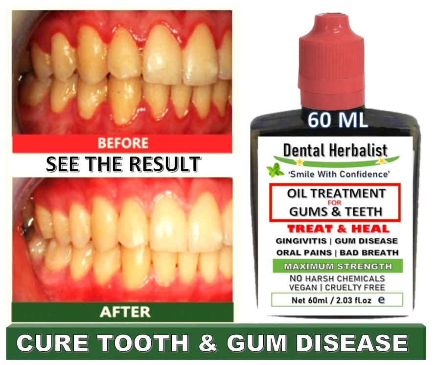 Gingivitis Treatment Over The Counter
