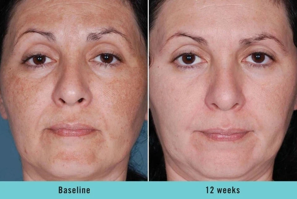 KOJIC ACID Skin Whitening Lightening Brightening Serum Bleaching/Spot Fade Cream - Image 3 of 4