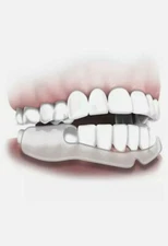 Plackers Dental Guard Stop Grinding Dental Night Protector Ready To Wear! NEW 2x